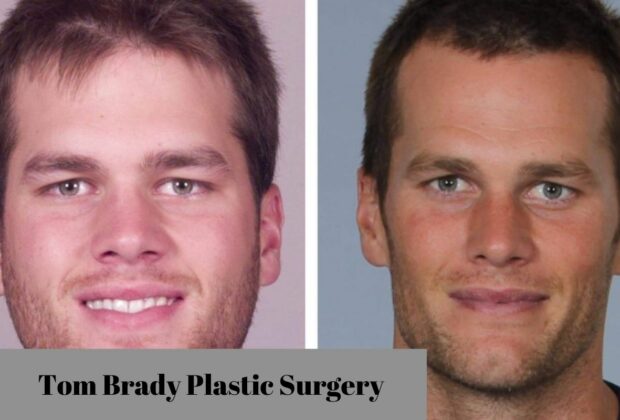 tom brady plastic surgery