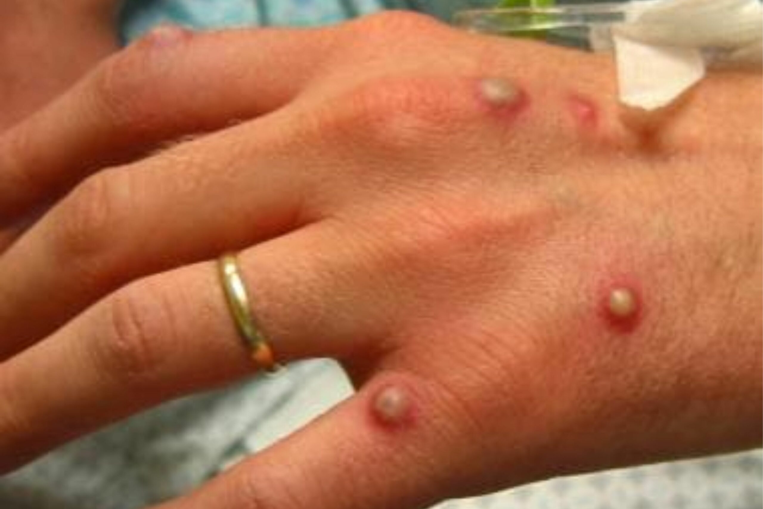 The First Suspected Case Of Monkeypox In Lake County Has Been Reported!