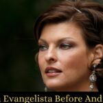 Linda Evangelista Before And After Surgery And What Is Linda Evangelista's Deformity?