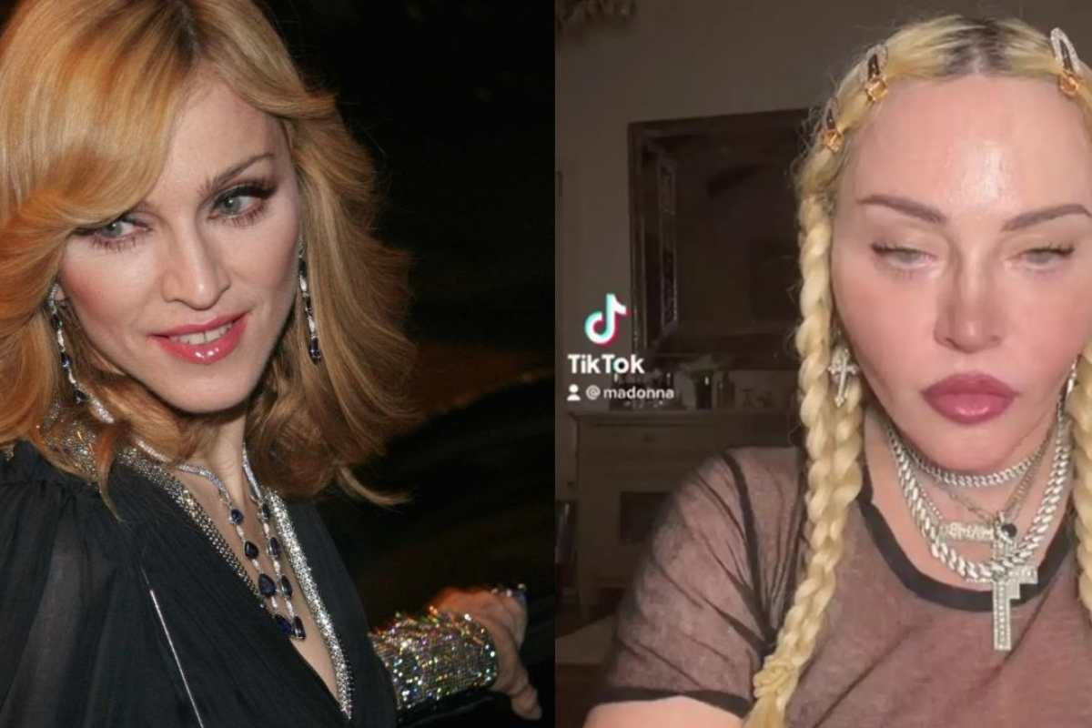 What Plastic Surgery Has Madonna Had