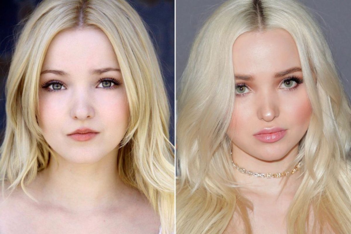 Dove Cameron Before and After Plastic Surgery Looks Will Shock You