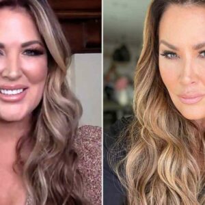 Emily Simpson's facelift