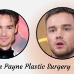 Liam Payne's Plastic Surgery